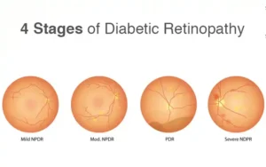 4 Stages of Diabetic Retinopathy